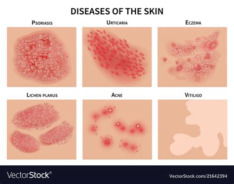 Skin Diseases Derma Infection Eczema And Vector Image