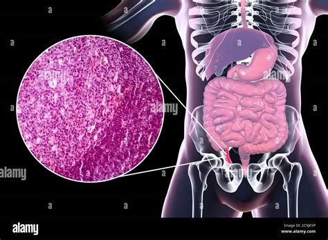 Appendix Anatomy Micrograph Hi Res Stock Photography And Images Alamy