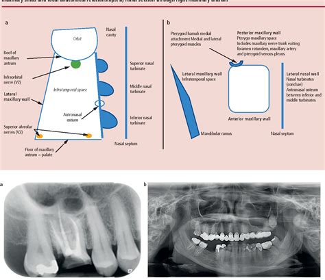 Maxillary Sinus Antrum Anatomy Anatomy Structure