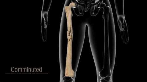 Common Types Of Bone Fractures By Madi7779 Videohive