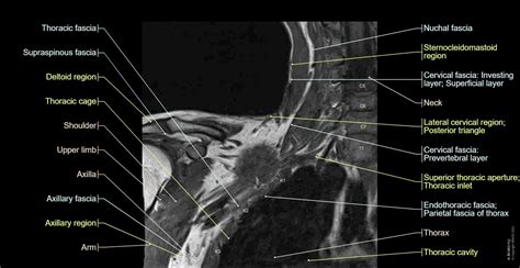 Brachial Plexus Mr Normal Anatomy E Anatomy