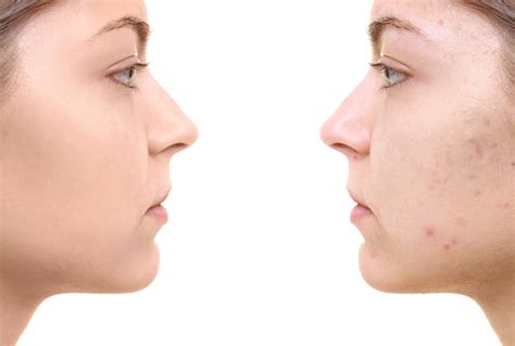 29 Acne Scars Types And Treatment Images