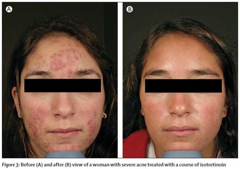 2 Months On Accutane Face Still Not Dry Help Prescription Acne