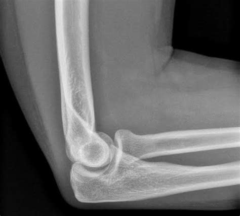 Normal Lateral Elbow Radiograph Radiology Case