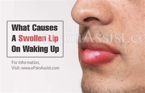 What Can Cause Swelling Of Lips And Eyes Lipstutorial Org