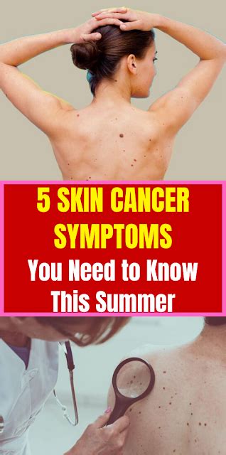 5 Skin Cancer Symptoms You Need To Know This Summer Passionofswathi