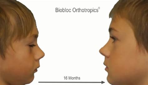 What Is Biobloc Orthotropics