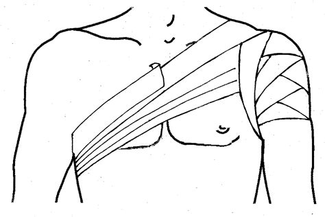 Таким образом повязка дезо помогает снять нагрузку. Колосовидная повязка на плечевой сустав: показания ...