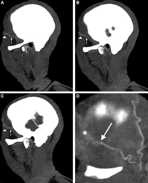 Diagnostic Utility Of Computed Tomographic Angiography In Giant Cell