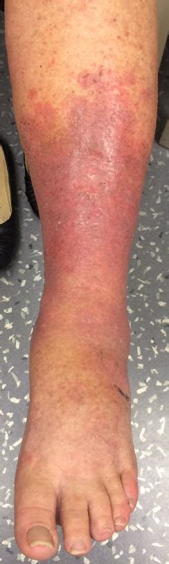 Leg Shortening Causes Red