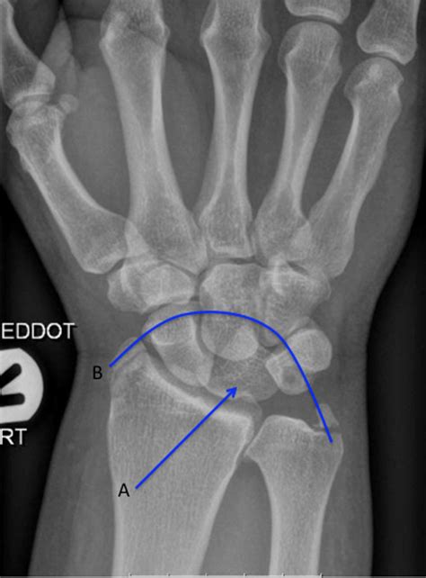 Radiological Signs Of A True Lunate Dislocation Bmj Case Reports