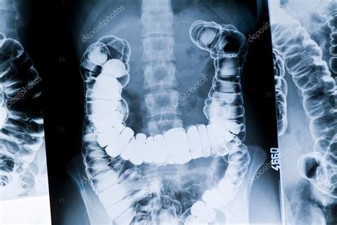 Radiography Of The Intestine — Stock Photo © Areadeposit 10485612