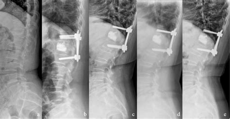 A 71 Year Old Female Patient With Osteoporotic Compression Fracture Of