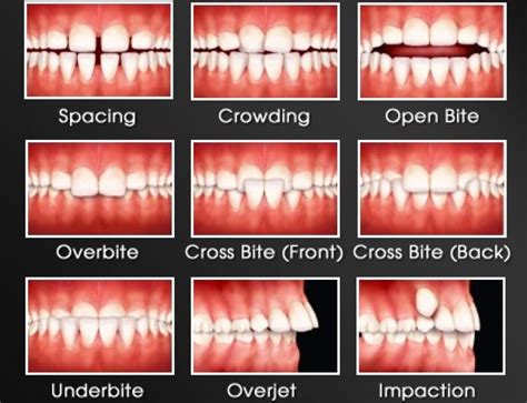 Orthodontic Treatment Can Help Stop Bedwetting Fraser Dental