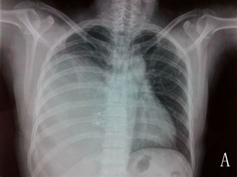 A Chest X Ray P A View Shows Huge Mass In The Right Thoracic Cavity
