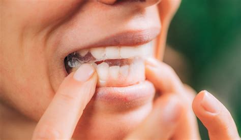 Why Do My Teeth Hurt After Whitening Strips Cavitiesgetaround