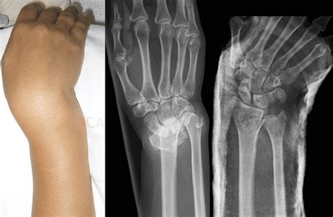 Moore Fracture Litfl Medical Blog Medical Eponym Library