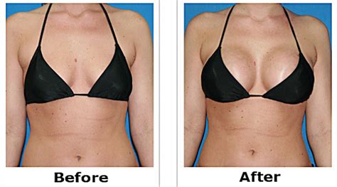 Brustvergrößerung vorher und nachher Real Before and After