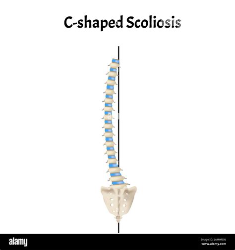 C Shaped Scoliosis Dextroscoliosis Levoscoliosis Spinal Curvature