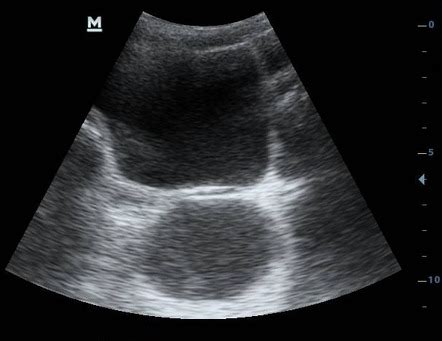 This may show up in ultrasound. Disseminated tuberculosis: on ultrasound | Image ...