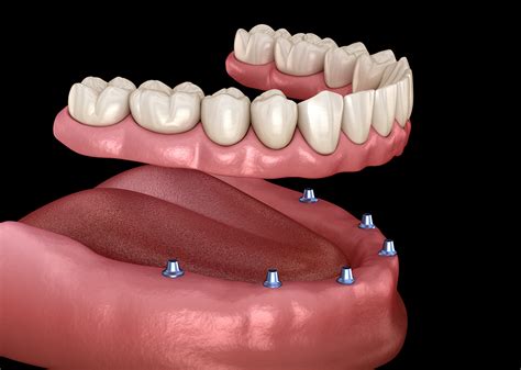 Dentures Glendale Az Complete And Partial Dentures