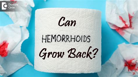 Aktualisieren My Patient Perspective What To Expect From Hemorrhoid