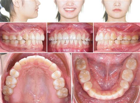 Bimaxillary Protrusion And Gummy Smile Treated With Clear Aligners
