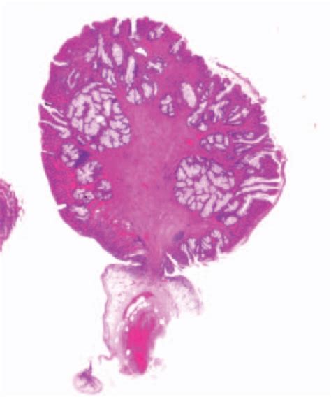 Figure 1 From Juvenile Colonic Polyp Occurring In The Vulva Semantic