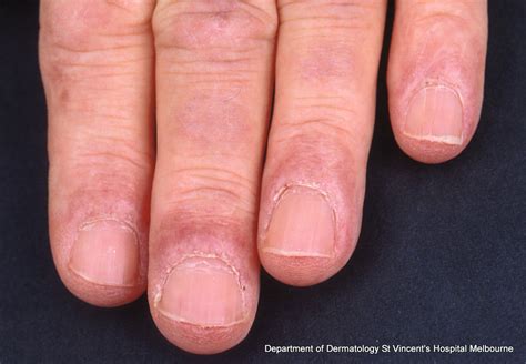 Acd A Z Of Skin Dermatomyositis