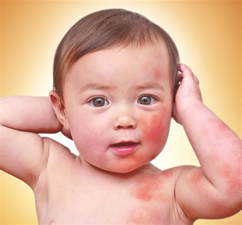 Rashes In Babies Causes Treatment Vinmec