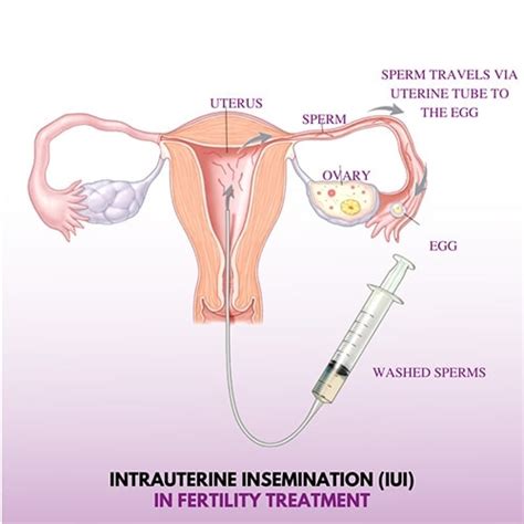 Intrauterine Insemination Treatment In Delhi Best IUI Centre Cost