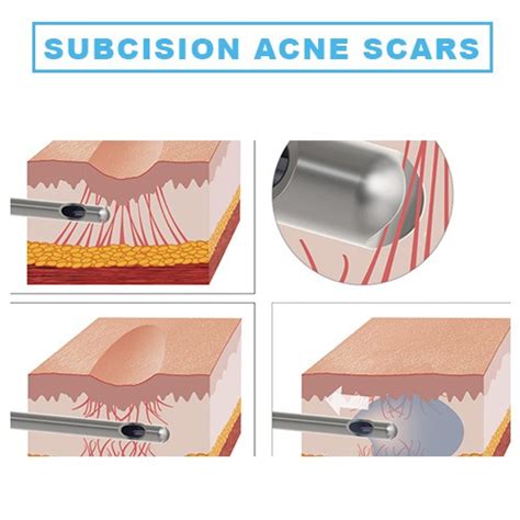 Subcision For Acne Scars Stellar Clinic