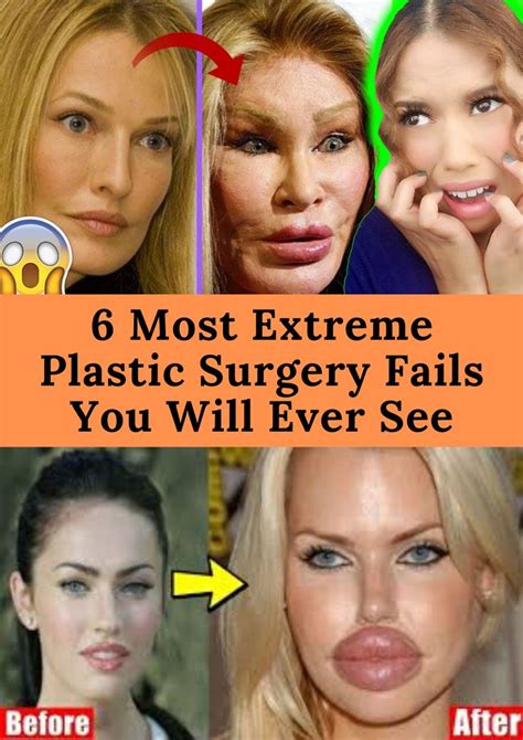 6 Most Extreme Plastic Surgery Fails You Will Ever See Plastic Surgery Extreme Plastic