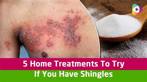 5 Home Treatments To Try If You Have Shingles Health Tips Youtube