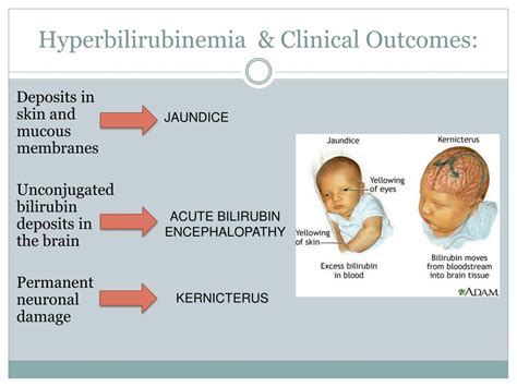 Ppt Neonatal Hyperbilirubinemia Powerpoint Presentation Free