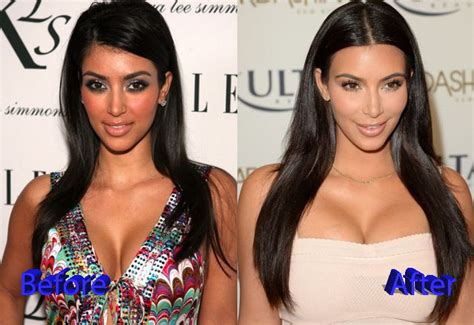 Pics Photos Kim Kardashian Before And After Cosmetic Surgery