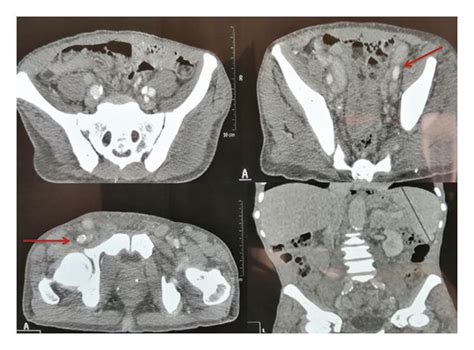 Multiple Mediastinal And Abdominal Lymphadenopathies With Central
