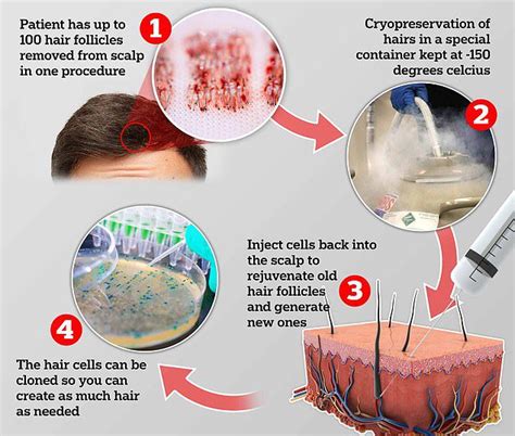 Men Can Now Freeze Their Follicles In A Hair Bank To Use Later In Life