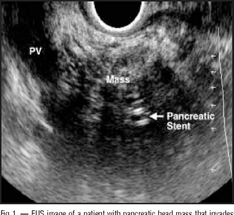 Figure 1 From Applications Of Endoscopic Ultrasonography In Pancreatic