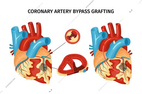 Anatomy Of Heart With Coronary Artery Bypass Grafting Flat Vector