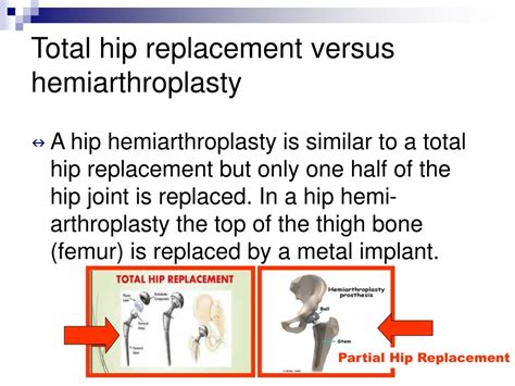 Ppt Hip Surgery And Mobility Powerpoint Presentation Free Download