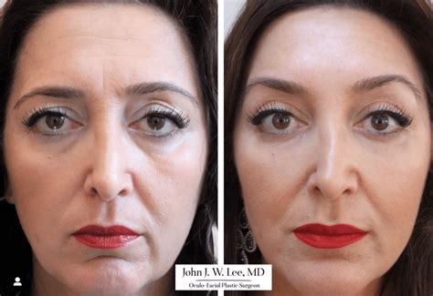 Brow Lift Surgery In Bryn Mawr And Main Line Dr John Jw Lee