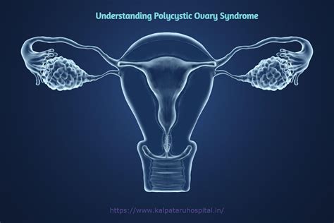 Understanding Polycystic Ovary Syndrome Kalpataruhospital