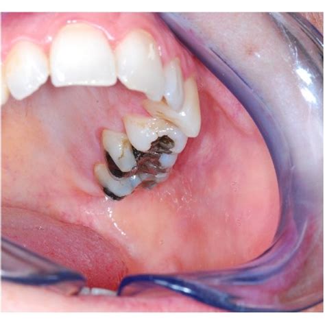 A Intraoral View Of The Right Buccal Mucosa Shows The Papilla Of