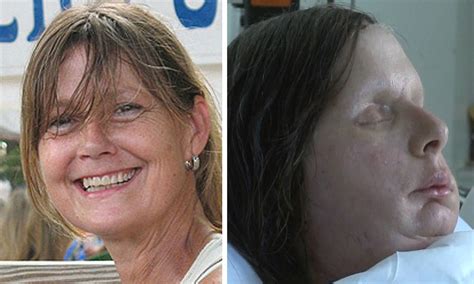 carla nash face transplant pictures chimp attack victim reveals her new face daily mail online