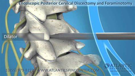 Endoscopic Foraminotomy Of The Lumbar And Cervical Spine Atlantic Spine Center