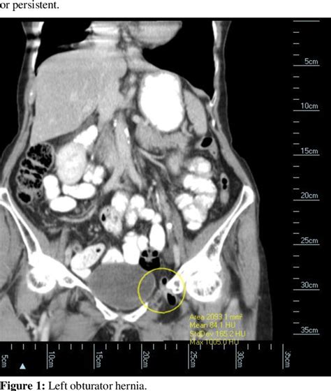 Figure 1 From A Rare Case Of Bilateral Incarcerated Obturator Hernias