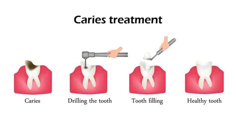 How Dentists Treat Tooth Decay Simply Dental Chatswood
