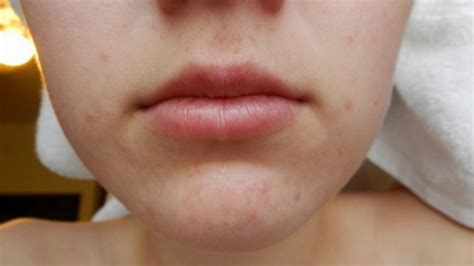 Difference Between Cold Sore And Pimple Youtube