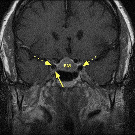 Pituitary Macroadenoma Diagnosis Mri Online